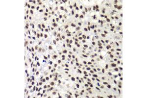 Immunohistochemistry of paraffin-embedded human lung cancer using NELFE antibody at dilution of 1:100 (x40 lens). (RDBP anticorps)