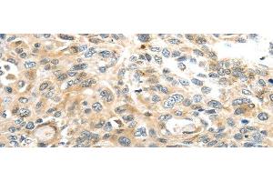 Immunohistochemistry of paraffin-embedded Human esophagus cancer tissue using TMPRSS4 Polyclonal Antibody at dilution 1:50 (TMPRSS4 anticorps)