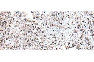 Immunohistochemistry of paraffin-embedded Human lung cancer tissue using UBE2E3 Polyclonal Antibody at dilution of 1:40(x200) (UBE2E3 anticorps)