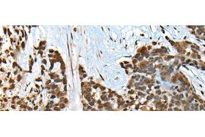 Immunohistochemistry of paraffin-embedded Human thyroid cancer tissue using CCDC12 Polyclonal Antibody at dilution of 1:60(x200) (CCDC12 anticorps)