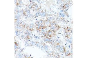 Immunohistochemistry of paraffin-embedded human liver cancer using TFR2 antibody (ABIN6128863, ABIN6149063, ABIN6149064 and ABIN6225172) at dilution of 1:100 (40x lens). (Transferrin Receptor 2 anticorps  (AA 582-801))