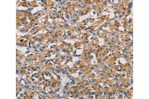 Immunohistochemistry of Human thyroid cancer using GPM6A Polyclonal Antibody at dilution of 1:50 (GPM6A anticorps)