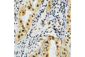 Immunohistochemical analysis of PRPF39 staining in human lung cancer formalin fixed paraffin embedded tissue section. (PRPF39 anticorps)