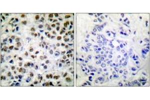 Immunohistochemistry analysis of paraffin-embedded human breast carcinoma, using POLR2A (Phospho-Ser1619) Antibody.