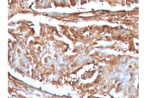 Formalin-fixed, paraffin-embedded human Renal Cell Carcinoma stained with Beta-2-Microglobulin Mouse Monoclonal Antibody (B2M/961).