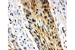 IHC-P: 14-3-3 sigma antibody testing of human oesophagus squama cancer tissue (14-3-3 sigma/SFN anticorps  (AA 140-156))