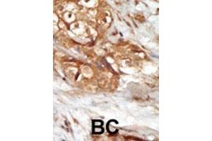 Formalin-fixed and paraffin-embedded human cancer tissue reacted with the primary antibody, which was peroxidase-conjugated to the secondary antibody, followed by AEC staining. (MAP3K14 anticorps  (AA 119-148))