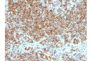 Formalin-fixed, paraffin-embedded human Lymphoma stained with CD45 Monoclonal Antibody (SPM569+SPM570).