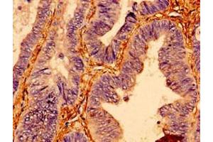 Immunohistochemistry of paraffin-embedded human colon cancer using ABIN7172487 at dilution of 1:100