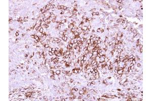 IHC-P Image Immunohistochemical analysis of paraffin-embedded human breast cancer, using CD40, antibody at 1:250 dilution.