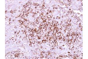 IHC-P Image Immunohistochemical analysis of paraffin-embedded human breast cancer, using CD40, antibody at 1:250 dilution. (CD40 anticorps  (Center))