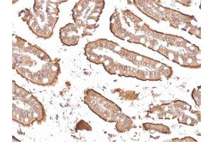 Formalin-fixed, paraffin-embedded human Small Intestinal Carcinoma stained with Villin-Monospecific Recombinant Mouse Monoclonal Antibody (rVIL1/1325).