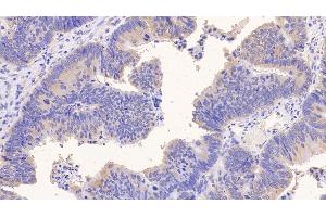 Detection of PIIINP in Human Colorectal cancer Tissue using Monoclonal Antibody to Procollagen III N-Terminal Propeptide (PIIINP) (PIIINP anticorps)