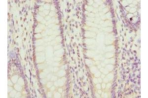 Immunohistochemistry of paraffin-embedded human colon cancer using ABIN7164852 at dilution of 1:100