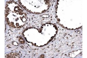 IHC-P Image UBE3A antibody detects UBE3A protein at nucleus on human ovarian carcinoma by immunohistochemical analysis. (ube3a anticorps)