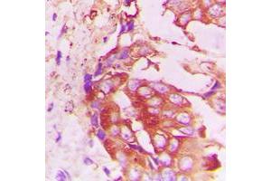Immunohistochemical analysis of RhoH staining in human lung cancer formalin fixed paraffin embedded tissue section.