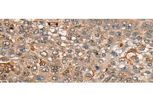 Immunohistochemistry of paraffin-embedded Human liver cancer tissue using CDT1 Polyclonal Antibody at dilution of 1:45(x200) (CDT1 anticorps)