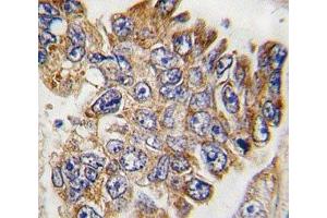 IHC analysis of FFPE human lung carcinoma tissue stained with GRB2 antibody