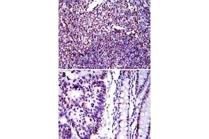 Immunohistochemical analysis of paraffin-embedded human tonsil tissue (A) and human colon cancer tissue (B) using XRCC5 monoclonal antobody, clone 5C5  with DAB staining. (XRCC5 anticorps)