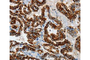 Immunohistochemistry of Human thyroid cancer using ASB4 Polyclonal Antibody at dilution of 1:40