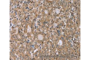 Immunohistochemistry of Human prostate cancer using RAB39B Polyclonal Antibody at dilution of 1:45 (RAB39B anticorps)