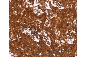 Immunohistochemistry of Human thyroid cancer using HCAR2 Polyclonal Antibody at dilution of 1:40 (HCAR2 anticorps)