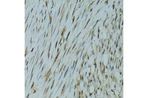 Immunohistochemistry of paraffin-embedded human uterine cancer using GABPA antibody (ABIN6127940, ABIN6140889, ABIN6140892 and ABIN6224475) at dilution of 1:100 (40x lens).