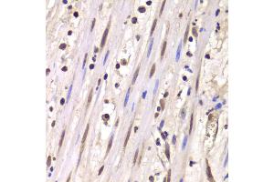 Immunohistochemistry of paraffin-embedded human mammary cancer using LSM4 antibody (ABIN5973492) at dilution of 1/100 (40x lens). (LSM4 anticorps)