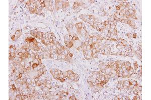 IHC-P Image SMAD9 antibody detects SMAD9 protein at cytoplasm on human breast carcinoma by immunohistochemical analysis. (SMAD9 anticorps)