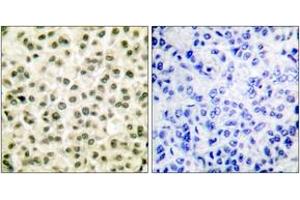 Immunohistochemistry analysis of paraffin-embedded human breast carcinoma tissue, using Ku70/80 Antibody. (Ku70/80 (AA 683-732) anticorps)