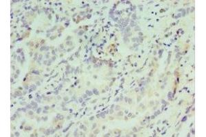 Immunohistochemistry of paraffin-embedded human lung cancer using ABIN7148809 at dilution of 1:100