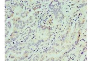 Immunohistochemistry of paraffin-embedded human lung cancer using ABIN7148809 at dilution of 1:100 (AFT7 anticorps  (AA 1-117))