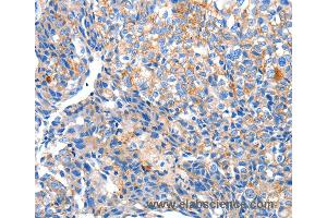 Immunohistochemistry of Human ovarian cancer using HCN2 Polyclonal Antibody at dilution of 1:80