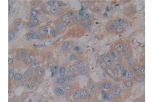 Detection of NOS2 in Human Breast cancer Tissue using Polyclonal Antibody to Nitric Oxide Synthase 2, Inducible (NOS2)