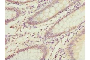Immunohistochemistry of paraffin-embedded human colon cancer using ABIN7150497 at dilution of 1:100 (DNAJA2 anticorps  (AA 233-412))