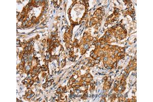 Immunohistochemistry of Human liver cancer using SLC5A11 Polyclonal Antibody at dilution of 1:35 (Solute Carrier Family 5 (Sodium/inositol Cotransporter), Member 11 (SLC5A11) anticorps)