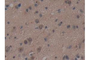 Detection of UBE1L in Human Glioma Tissue using Polyclonal Antibody to Ubiquitin Activating Enzyme E1 Like Protein (UBE1L) (UBA7 anticorps  (AA 429-488))