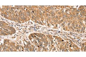 Immunohistochemistry of paraffin-embedded Human lung cancer using RPLP2 Polyclonal Antibody at dilution of 1:35 (RPLP2 anticorps)