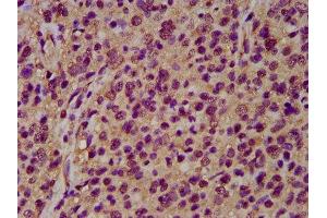 IHC image of ABIN7161362 diluted at 1:200 and staining in paraffin-embedded human glioma performed on a Leica BondTM system.