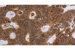 Immunohistochemistry of paraffin-embedded Human colon cancer using HSD17B4 Polyclonal Antibody at dilution of 1:30 (HSD17B4 anticorps)