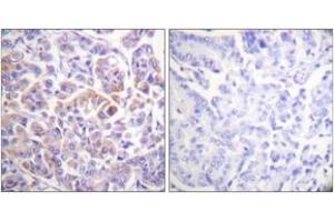 Immunohistochemistry analysis of paraffin-embedded human breast carcinoma tissue, using C-RAF (Ab-296) Antibody. (RAF1 anticorps  (AA 271-320))