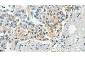 Immunohistochemistry of paraffin-embedded Human breast cancer tissue using DGK beta Polyclonal Antibody at dilution 1:60 (DGKB anticorps)