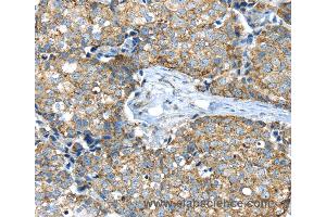 Immunohistochemistry of Human colon cancer using IFNA2 Polyclonal Antibody at dilution of 1:40 (IFNA2 anticorps)