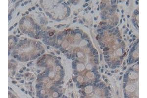 Detection of ABCC2 in Human Stomach cancer Tissue using Polyclonal Antibody to ATP Binding Cassette Transporter C2 (ABCC2)