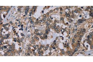 Immunohistochemistry of paraffin-embedded Human liver cancer using NECTIN4 Polyclonal Antibody at dilution of 1:60 (PVRL4 anticorps)