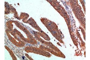 Immunohistochemical analysis of paraffin-embedded human-colon-cancer, antibody was diluted at 1:200