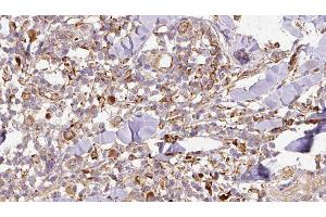 ABIN6276766 at 1/100 staining Human Melanoma tissue by IHC-P. (SPARC anticorps  (Internal Region))