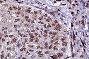 ABIN6266678 at 1/100 staining human lung carcinoma tissue sections by IHC-P. (XRCC3 anticorps  (N-Term))