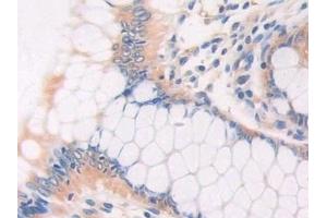 Detection of CECR1 in Human Colorectal cancer Tissue using Polyclonal Antibody to Cat Eye Syndrome Chromosome Region, Candidate 1 (CECR1) (CECR1 anticorps  (AA 30-511))