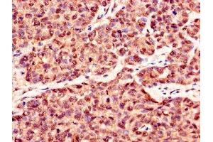 Immunohistochemistry of paraffin-embedded human ovarian cancer using ABIN7146893 at dilution of 1:100